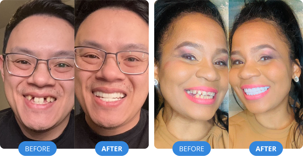 The Viral 'Clip-On' Secret That's Giving Americans Perfect Teeth ...