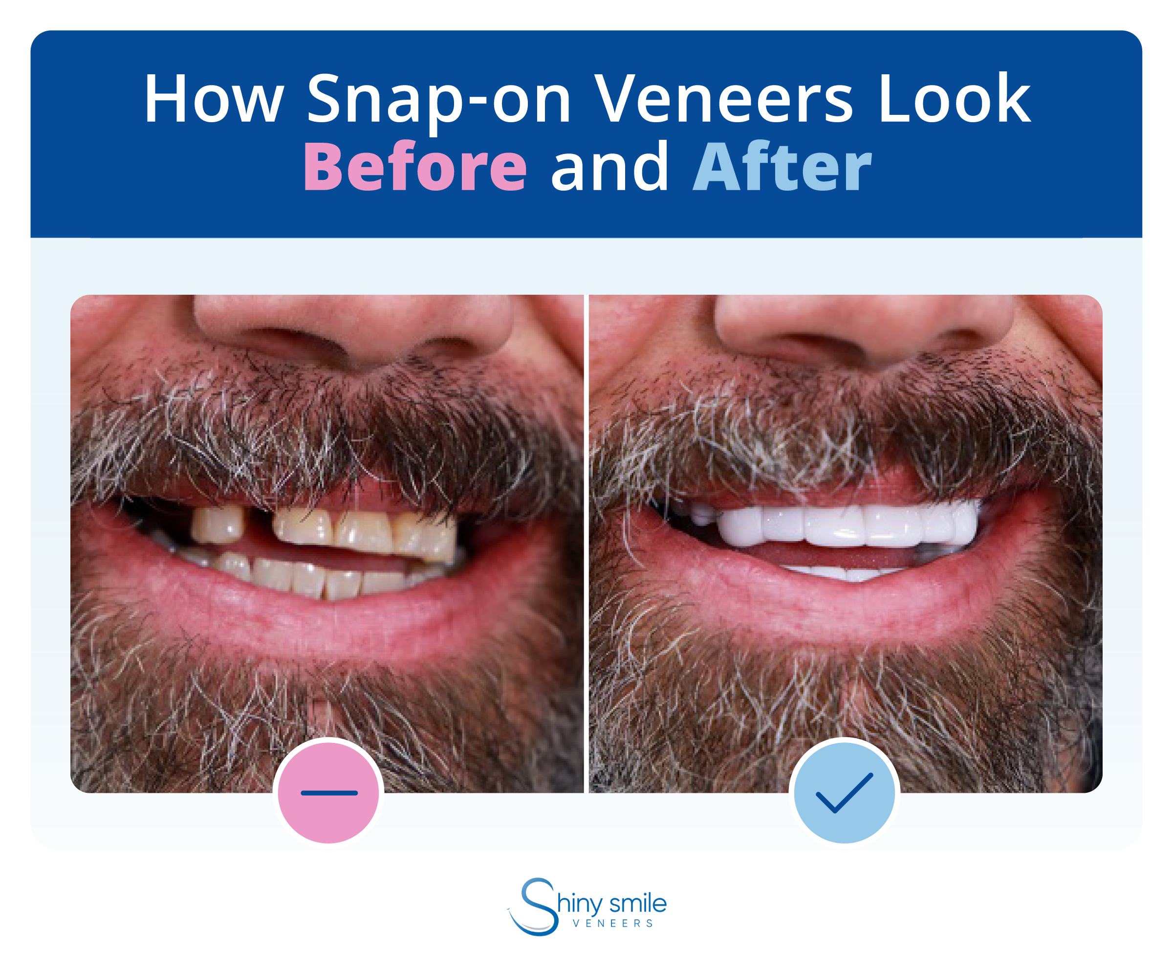 before and after photo of snap-on veneers