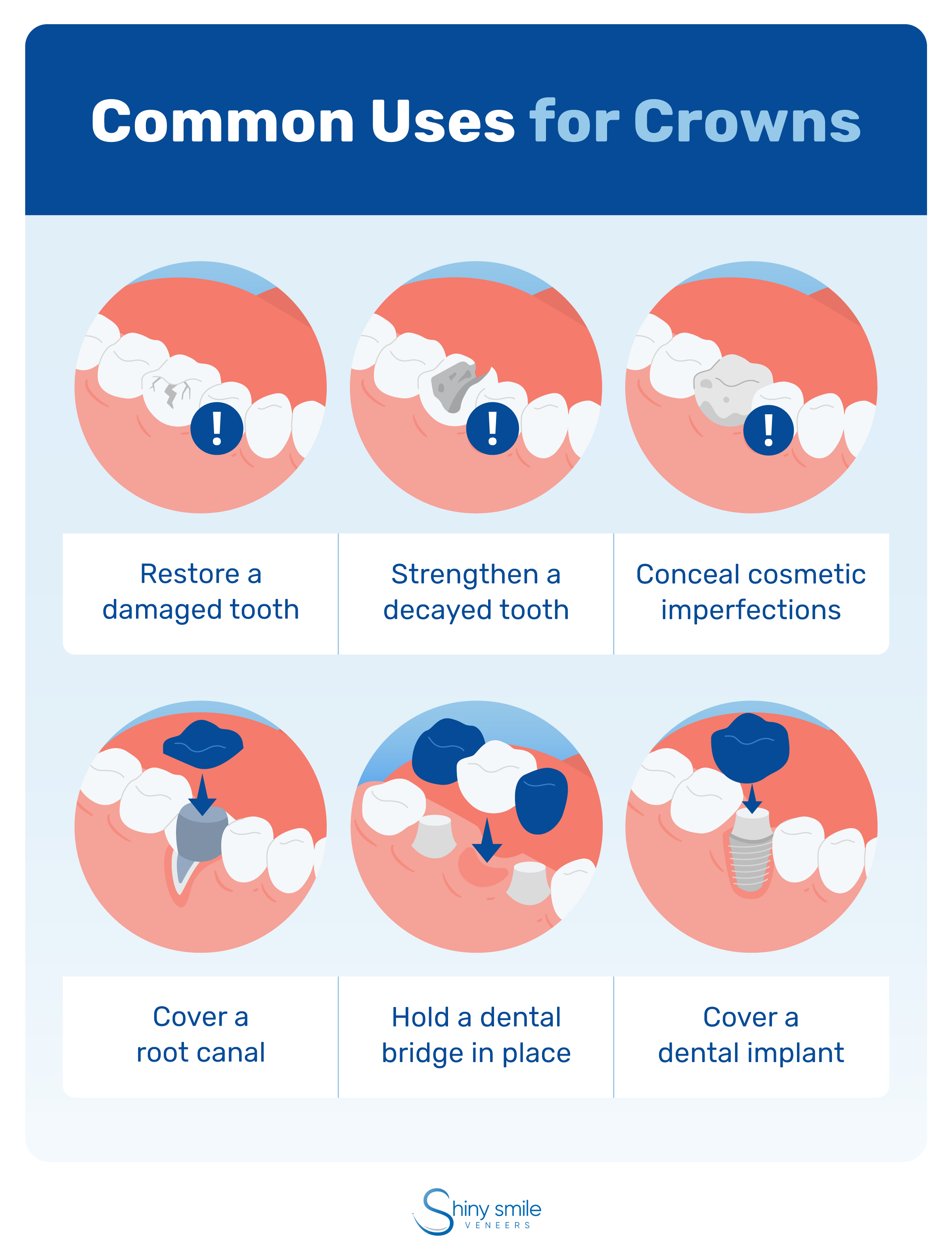 Common uses for dental crowns