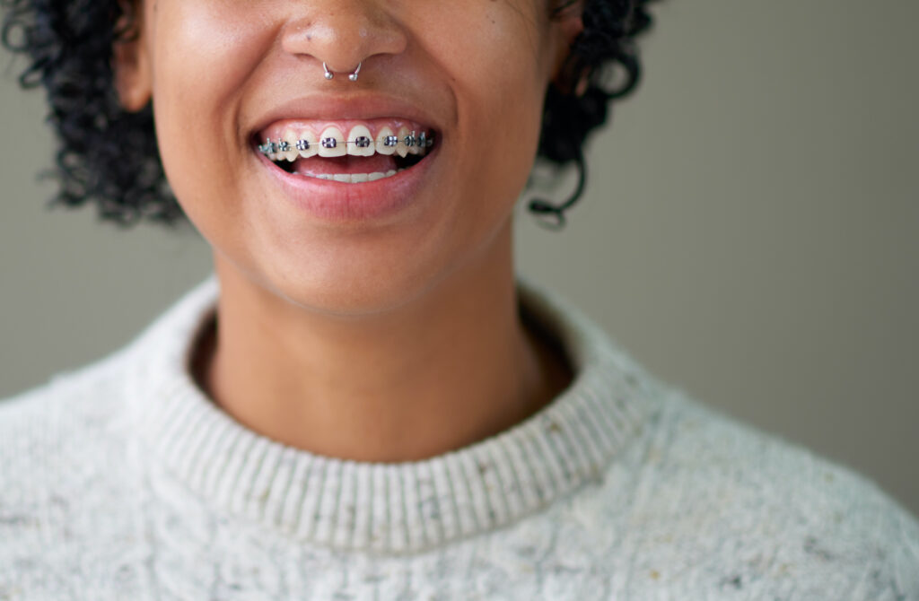 photo of a woman smiling with braces