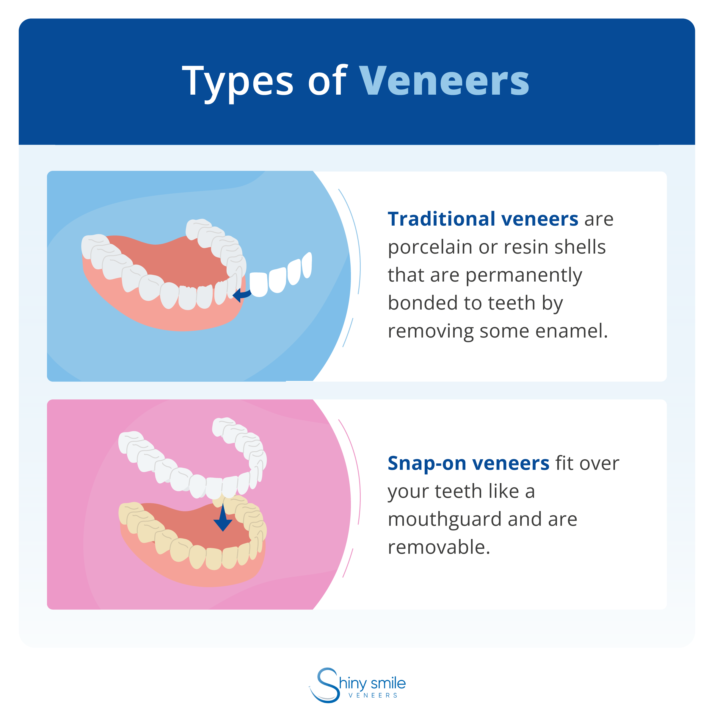 Two types of veneers