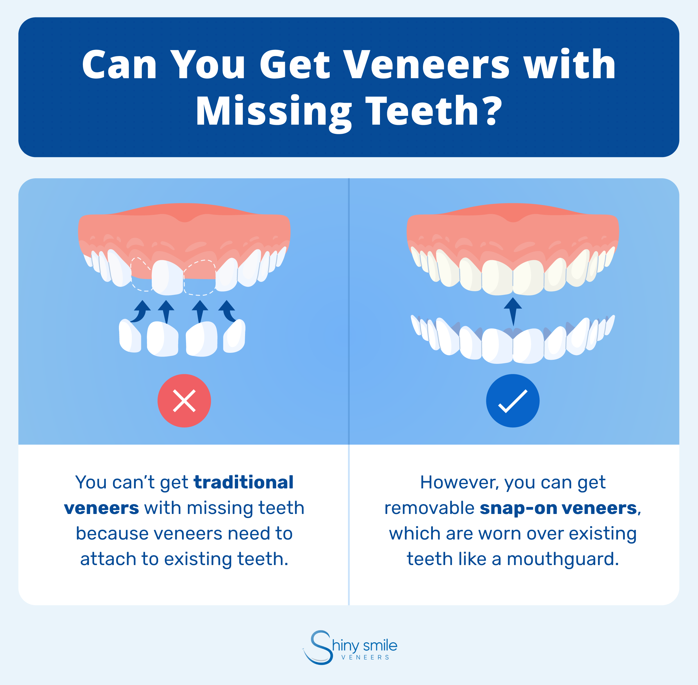 Why you can’t get traditional veneers with missing teeth