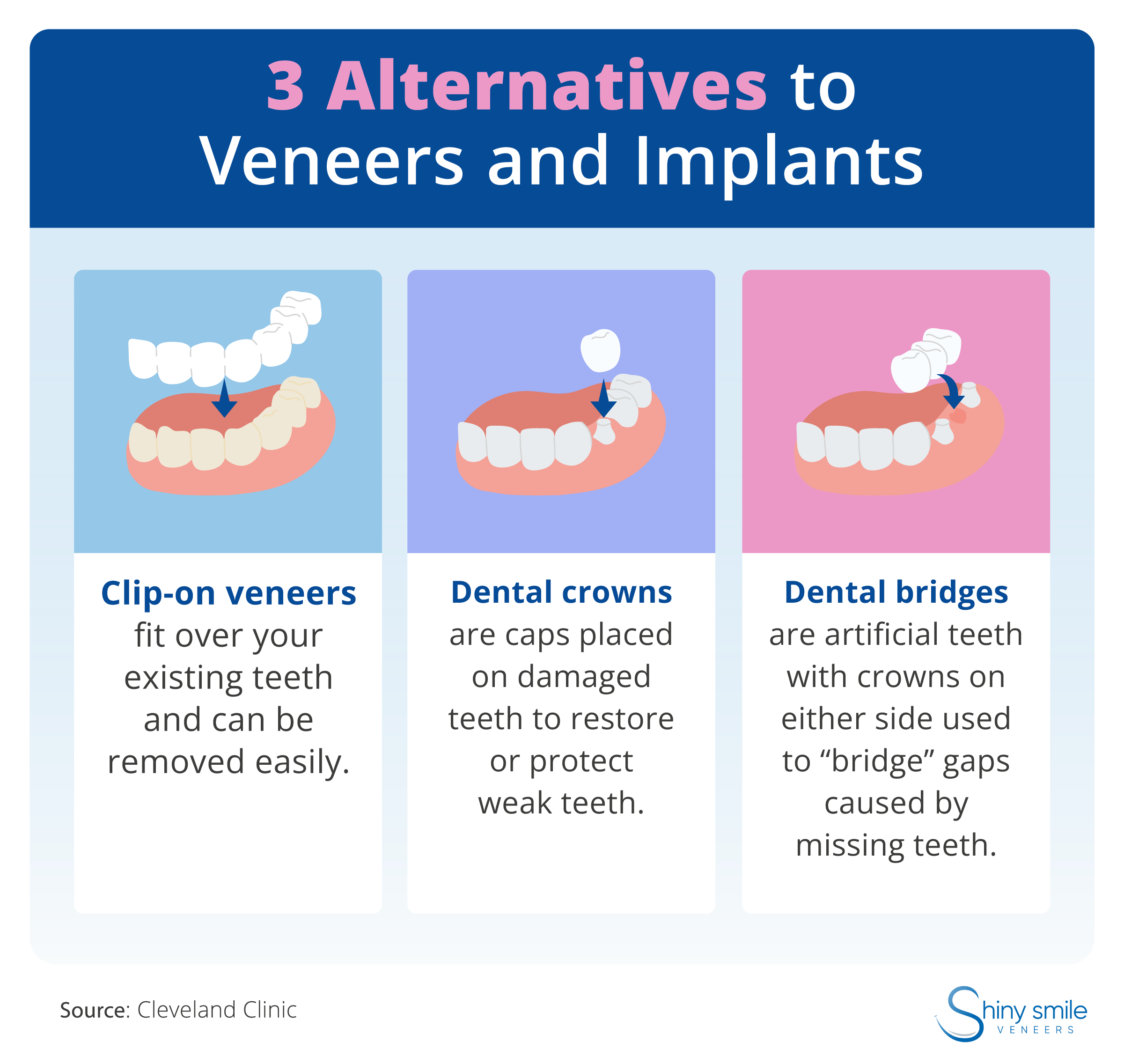 A list of alternatives to veneers and implants 