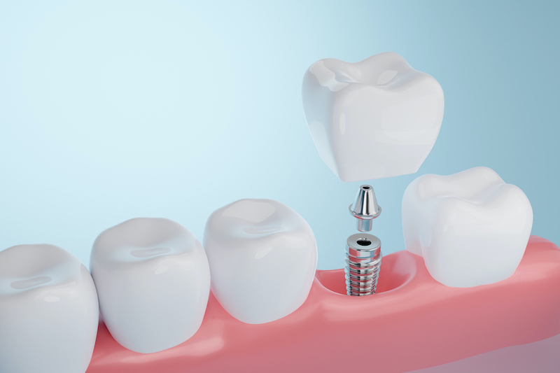 The anatomy of a dental implant