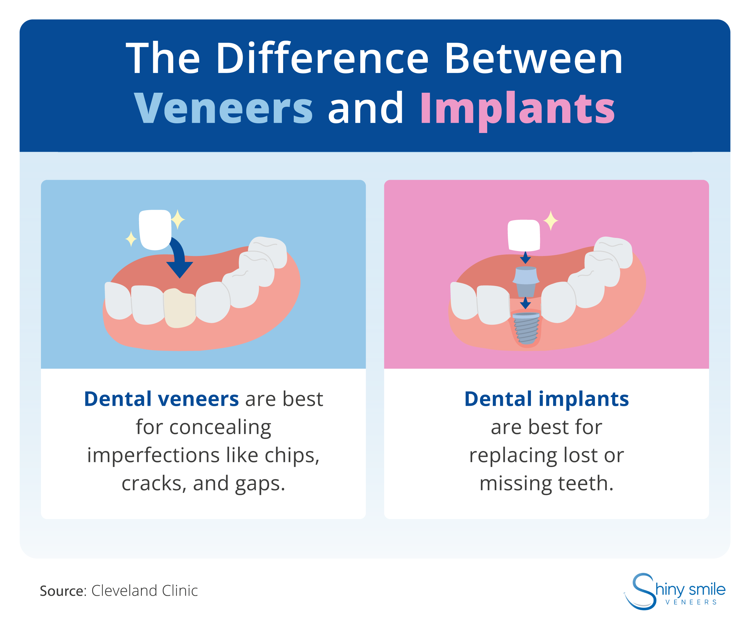 A breakdown of the difference between dental veneers and implants