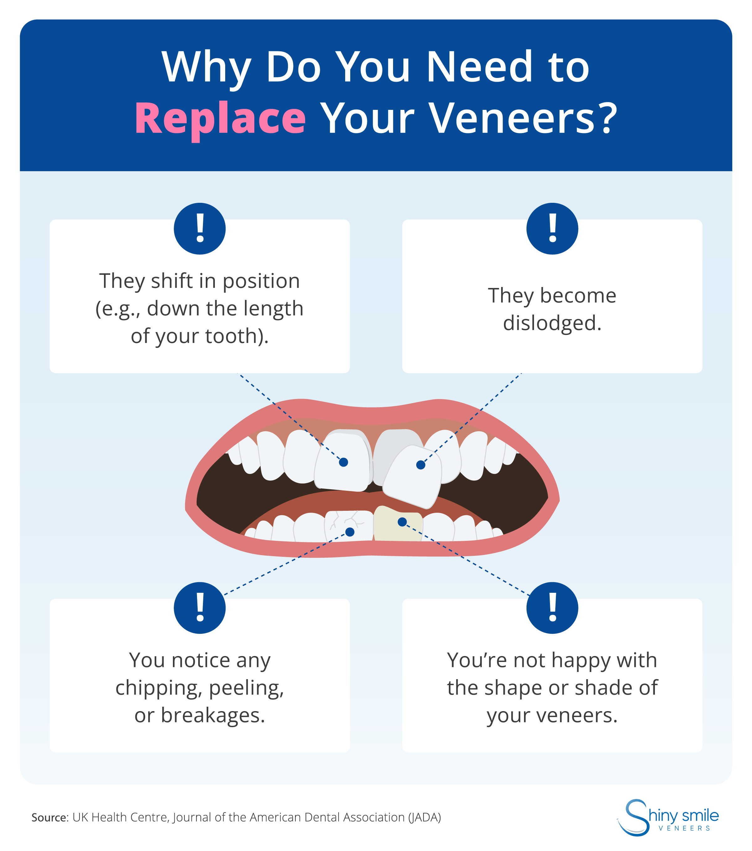 An illustration of why veneers may need to be replaced