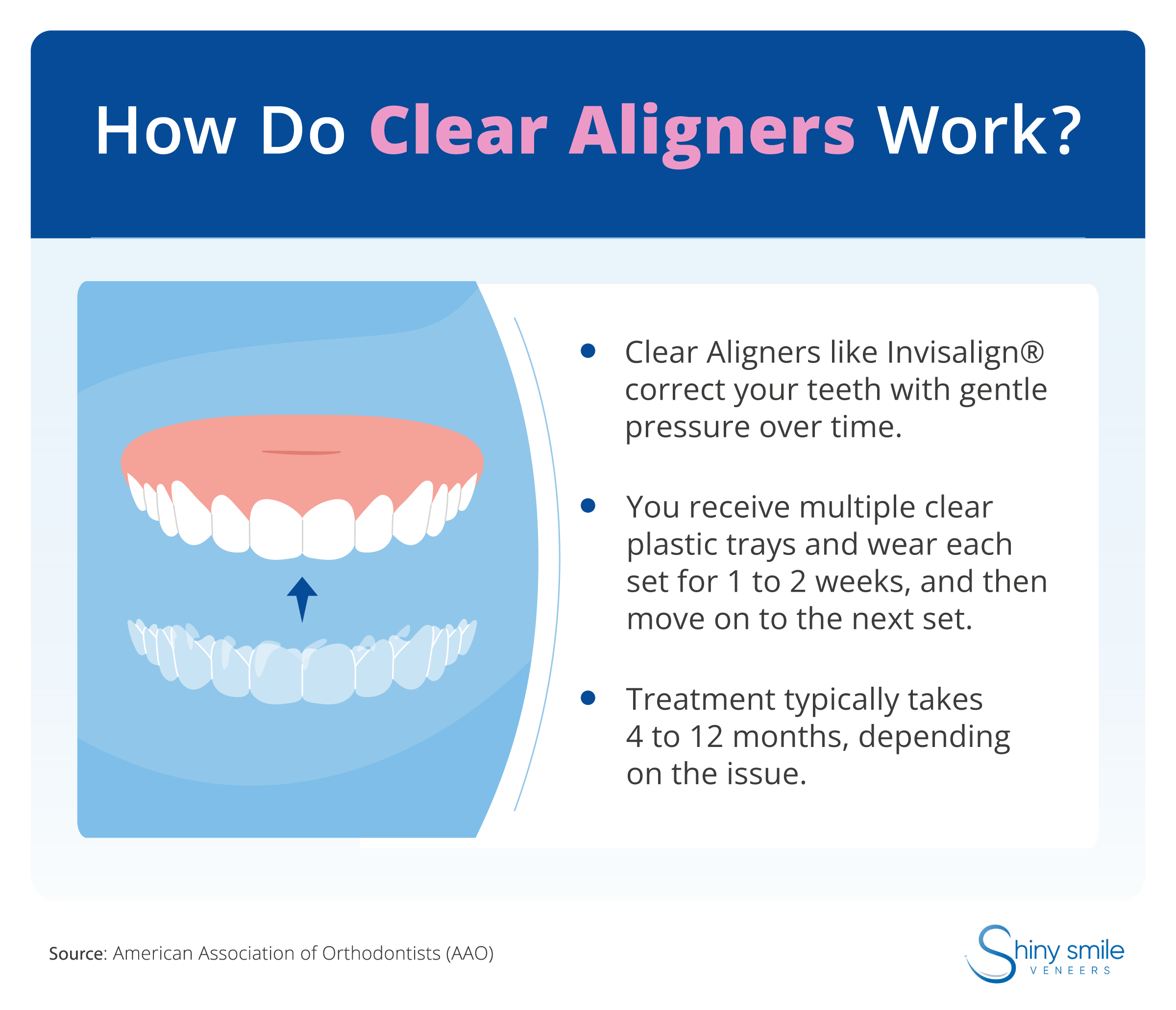 An explanation of how clear aligners work