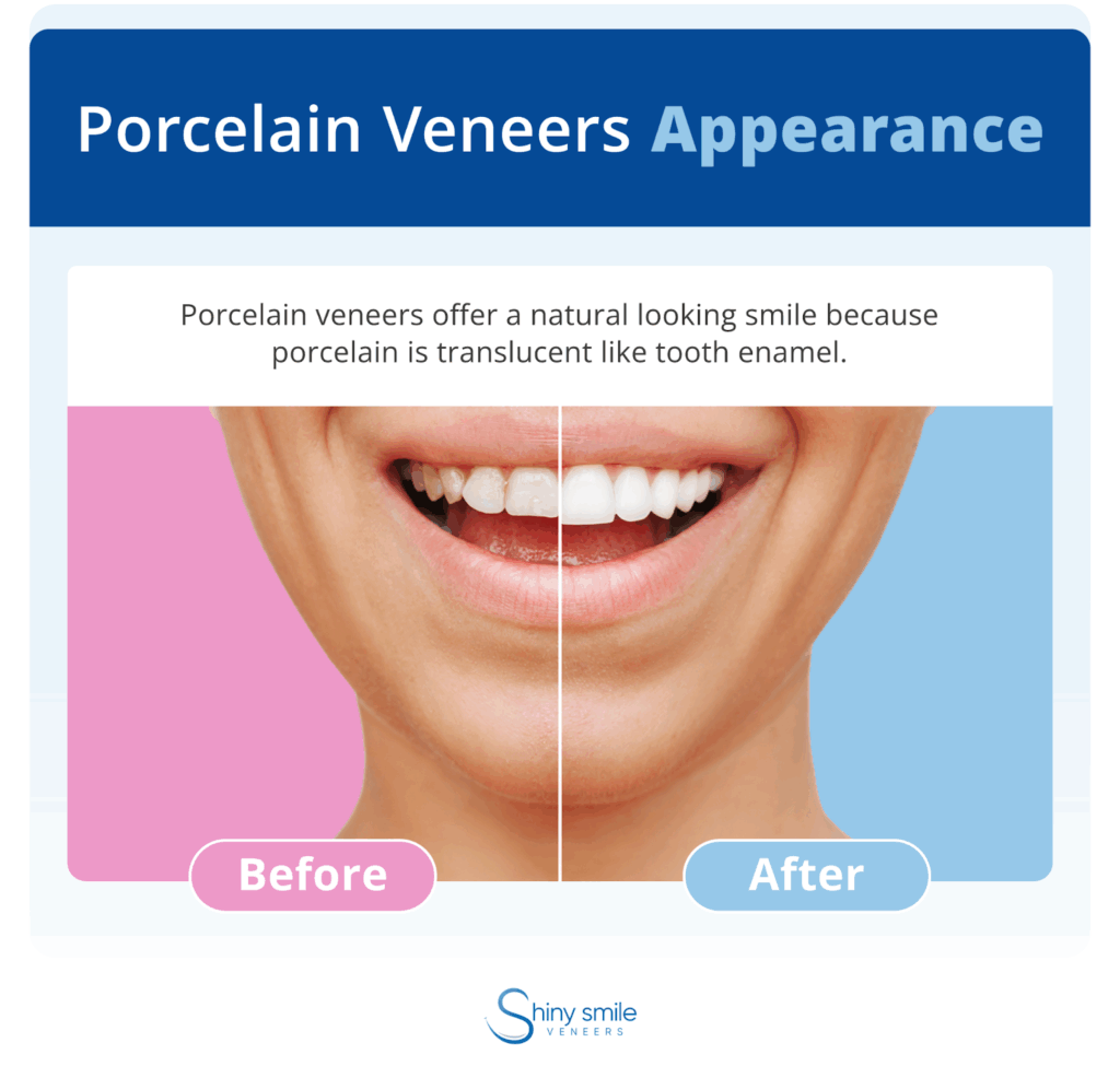 teeth before and after porcelain veneers