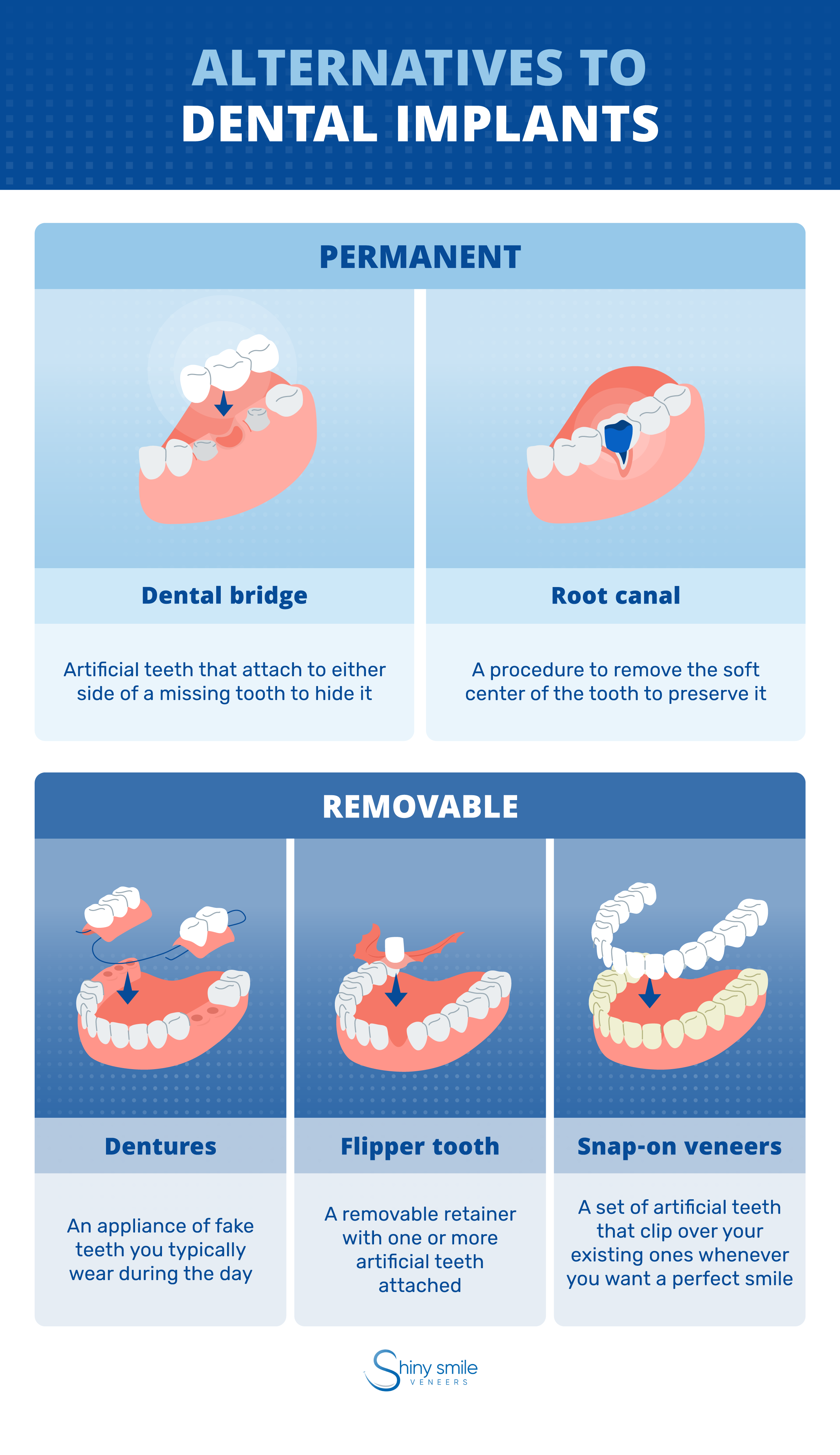 List of tooth implant alternatives