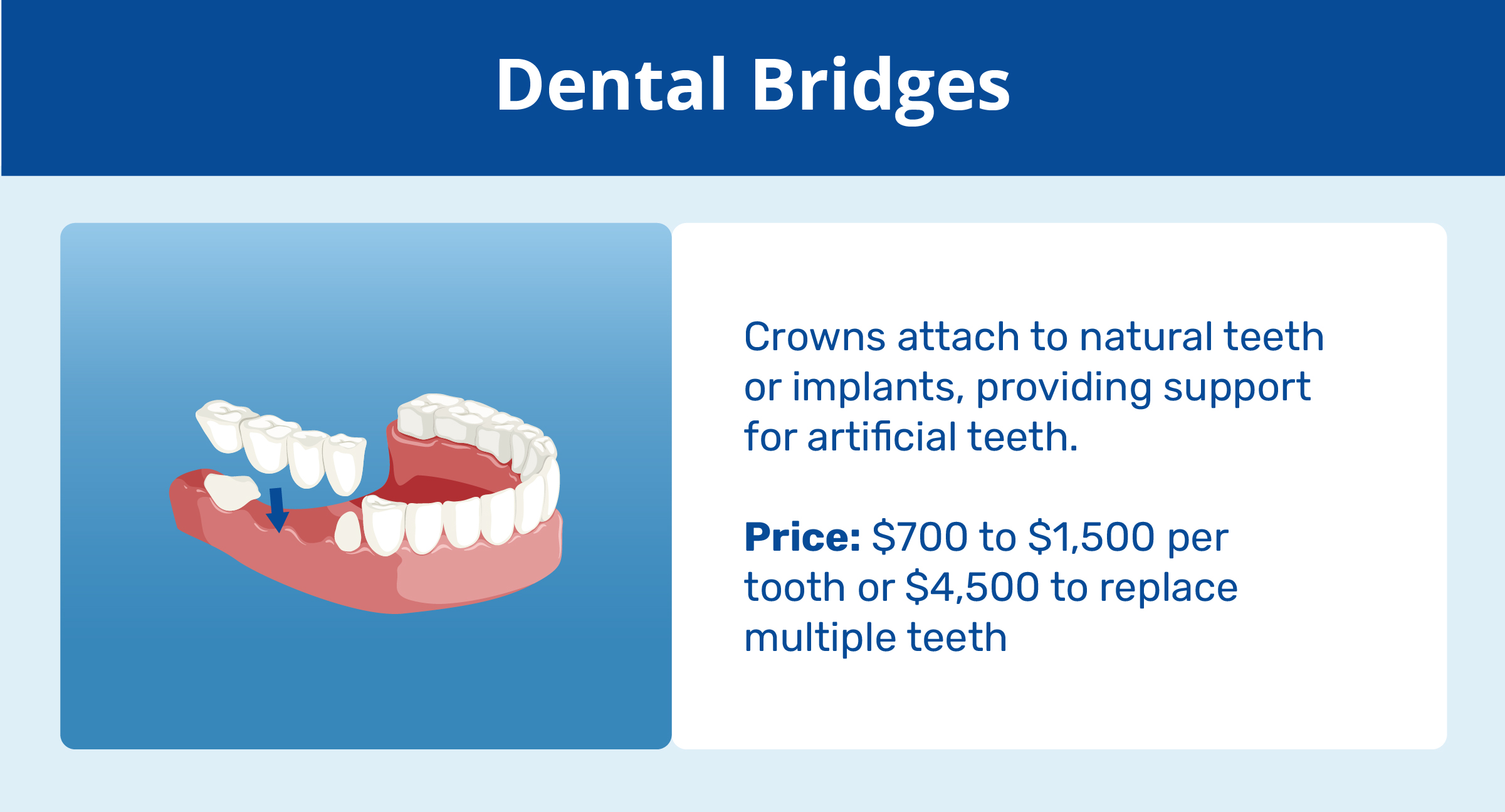 dental bridges explanation and price