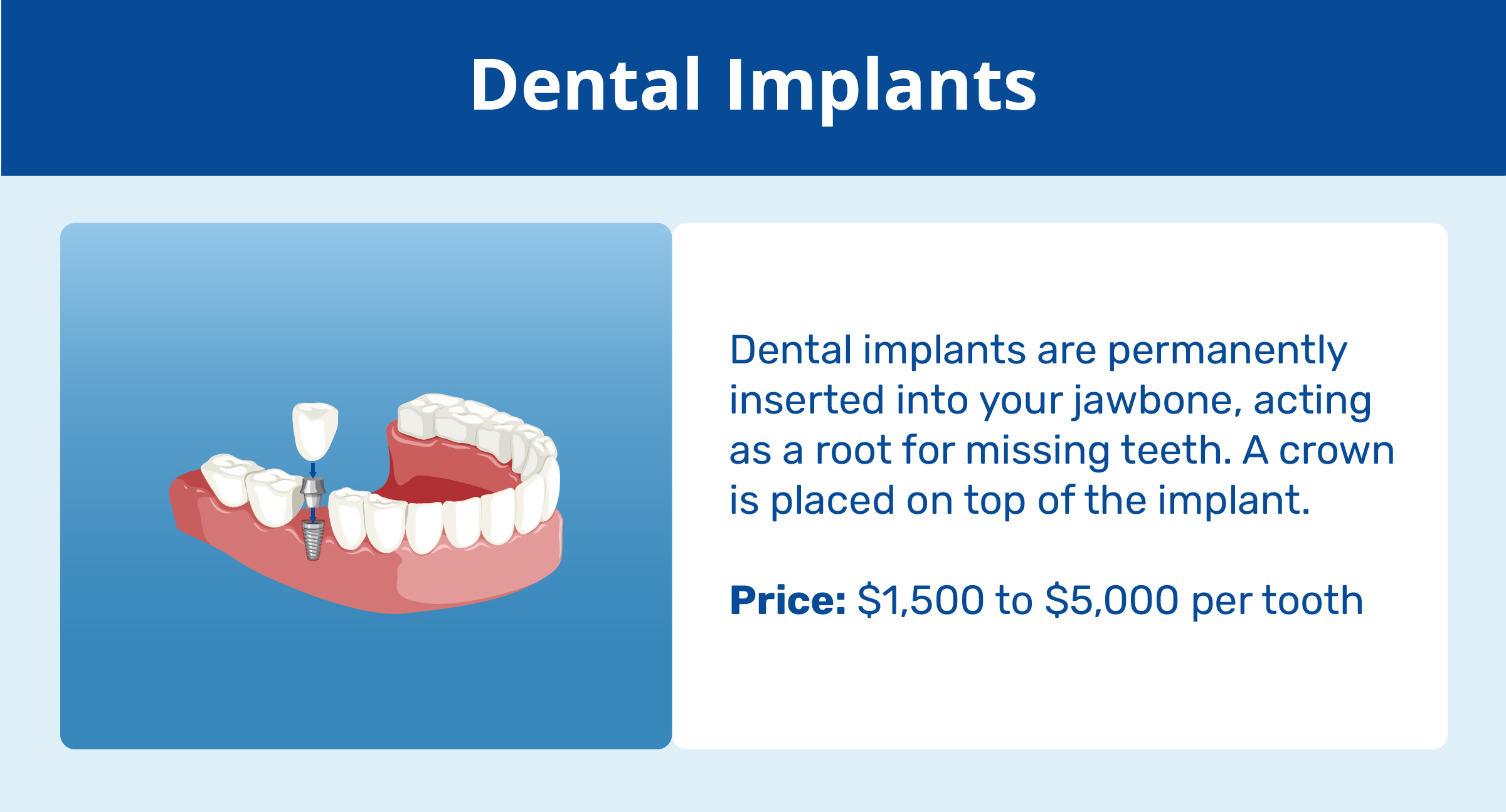 dental implants explanation and price
