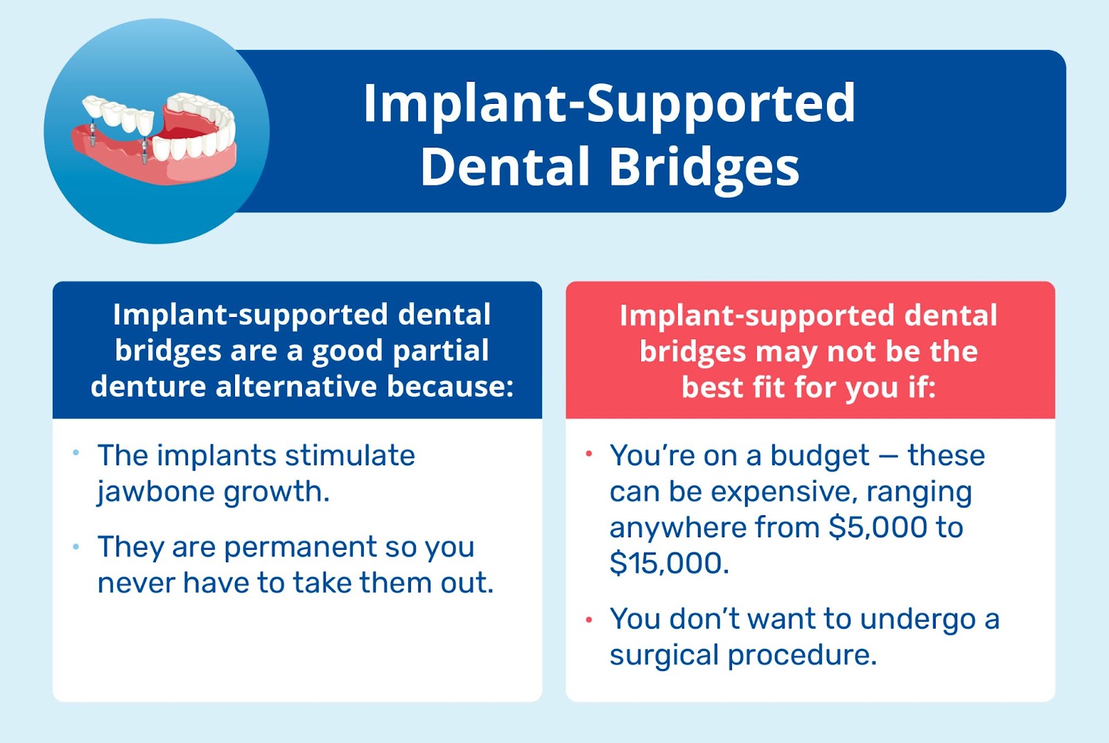 implant-supported dental bridges