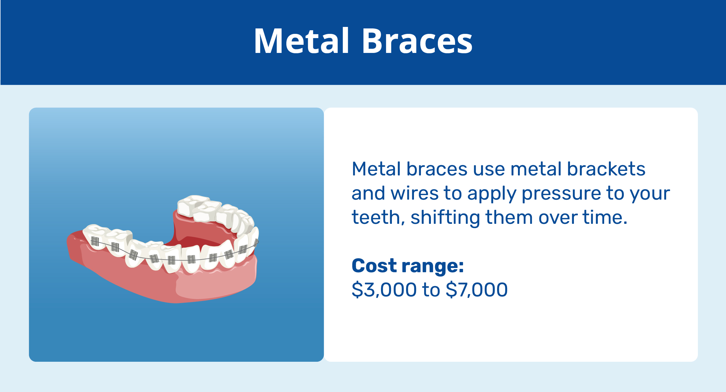 metal braces and cost range